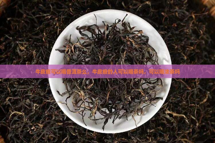 牛皮癣可以喝普洱茶么