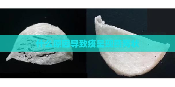 什么原因导致痰呈现燕窝状